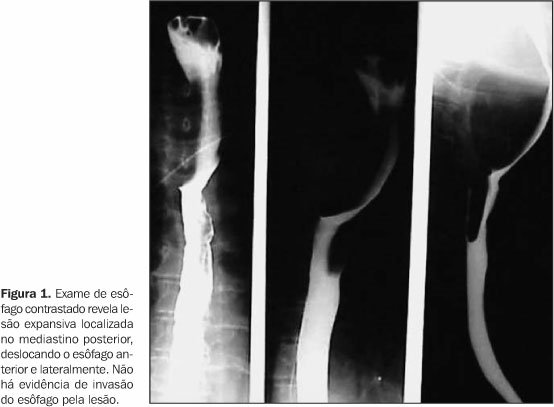 Esôfago - o esôfago é um órgão tubular que mede 25 cm de comprimento. Ocupa parte da região cervical, mediastino superior e mediastino posterior.