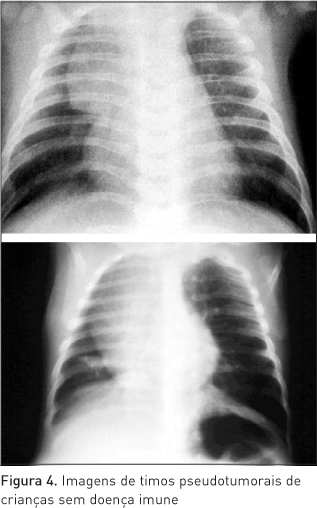 MEDIASTINO É definido como o espaço na cavidade torácica limitado anteriormente pelo esterno, posteriormente pelos corpos vertebrais, superiormente pelo intróito torácico, inferiormente pelo