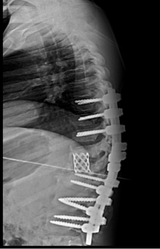 Figura 3 - Reconstrução anterior da coluna com cilindro de rede em titânio Quando comparamos os diversos segmentos da coluna vertebral afetados constatamos presença de deformidades cifóticas mais