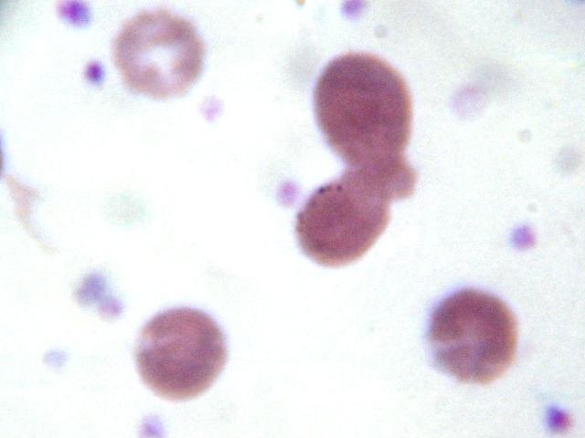 37 associadas com anemia normocítica normocrômica e aparecem, particularmente, após a esplenectomia (BUSH, 2004).