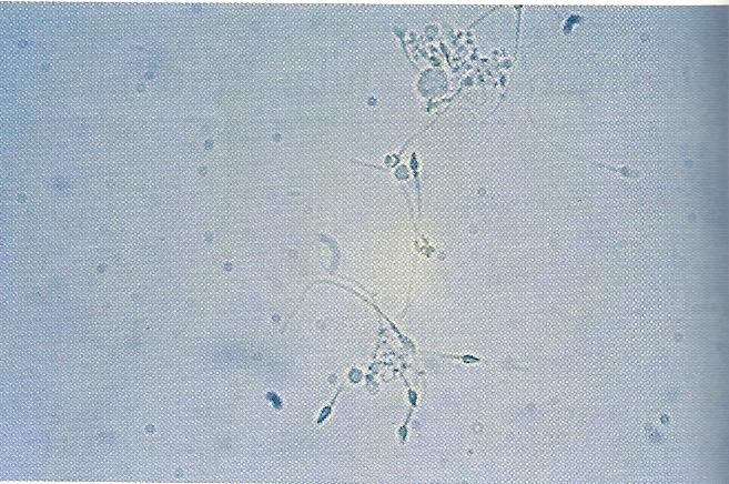 28 Figura 16 Bactérias e GBs corados por KOVA (x400), (Strasinger, 2009). A presença de bactérias pode ser indicativa de ITU tanto em trato urinário alto quanto baixo.