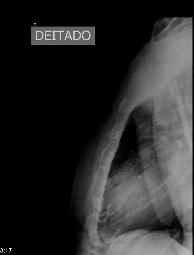 RX Radiografia do tórax revela alterações degenerativas