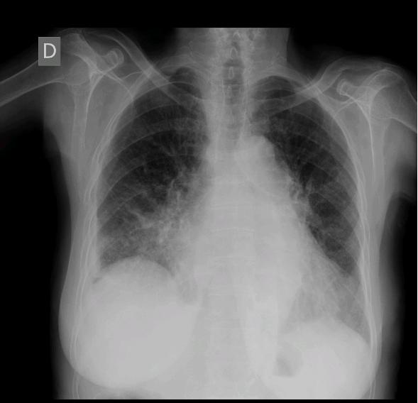 RX RX Radiografia do tórax revela aparente aumento da silhueta cardíaca