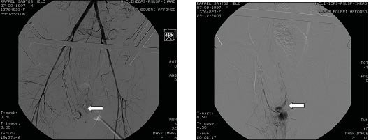 Bezerra TS et al. Lesão da artéria ilíaca interna bilateral associada com trauma pélvico.