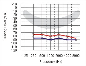 O ouvido humano Audiogramas Exemplos: Perda