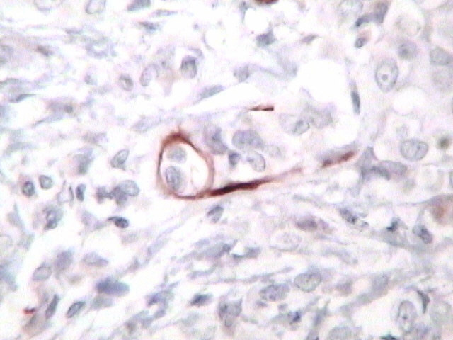 37 Figura 12 - Ductos mamários normais residuais entremeados no carcinoma invasor de mama, com coloração falso-positiva para CK 5/6.