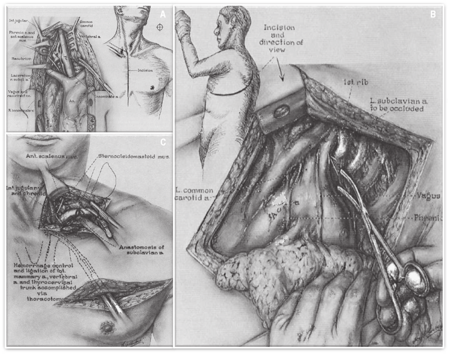 Figura 1 A: Ferida supra-clavicular direita; B Incisão supra-clavicular e libertação das inserções musculares da clavícula; C Desarticulação esternoclavicular; D Exposição dos vasos subclávios e