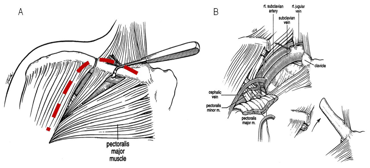 Figura 4 Abordagem transclavicular dos vasos subclávios. Adaptado de Penetrating injuries to the subclavian and axillary vessel. Journal of American College of Surgeons. 1999.