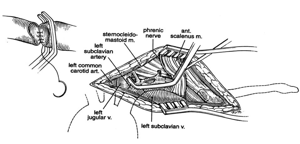 Figura 6 Reparação vascular dos vasos subclávios. Adaptado de Penetrating injuries to the subclavian and axillary vessels. Journal of American College of Surgeons. 1999.