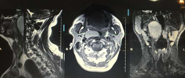 Foi submetido a abordagem cirúrgica com traqueostomia e por mandibulotomia paramediana que permitiu acesso aos espaço retro e parafaríngeo, com resseção completa do cisto, sem intercorrências