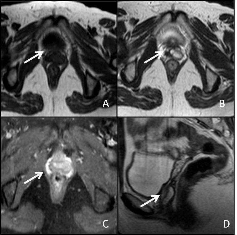 Tabela I Estadiamento da FIGO para o carcinoma da vagina.