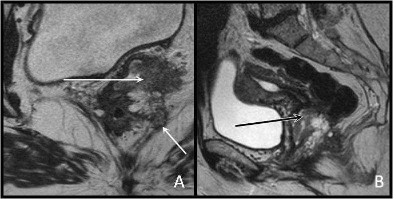 Fig. 14 - A) T2 sagital e B) T1 sagital com saturação de gordura e administração de contraste endovenoso: em doente com antecedentes de tumor do colo do útero, submetida a histerectomia radical,