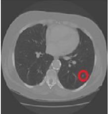 Figura 3 Imagens com indicação correta do nódulo pulmonar 5.