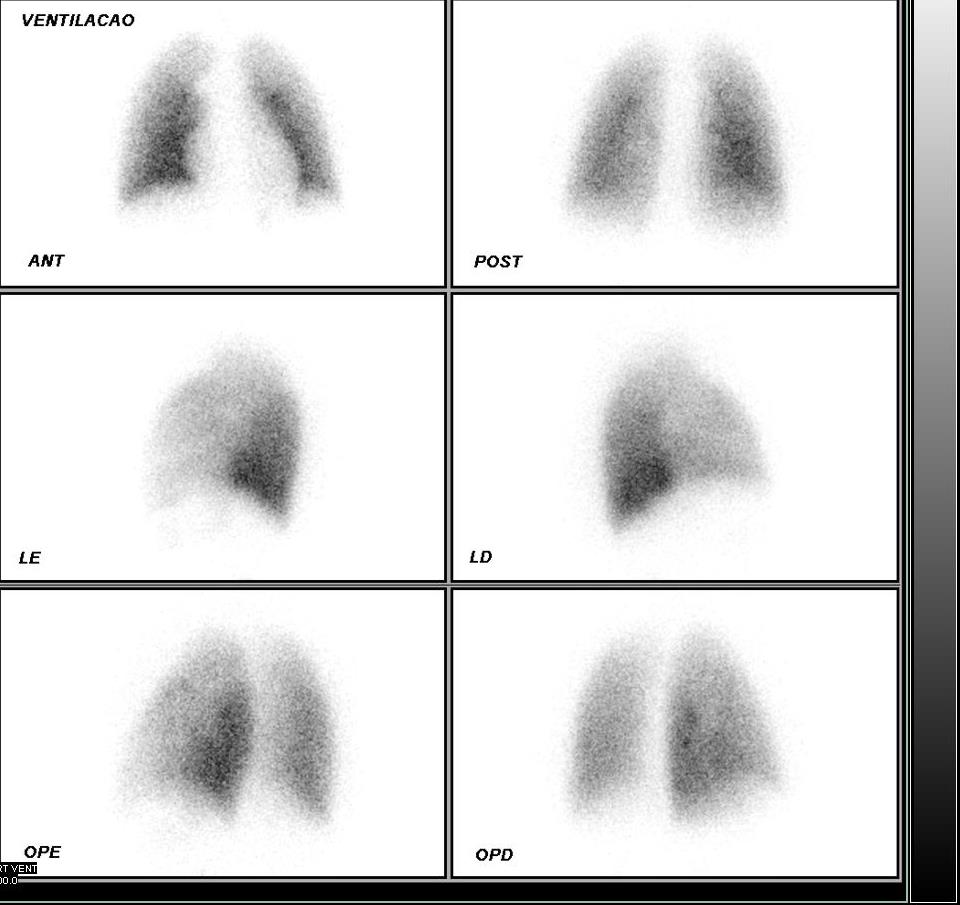 Perfusão e Ventilação Pulmonar Estudo