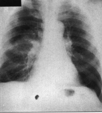 Embolia Pulmonar Imagens de Perfusão Anterior