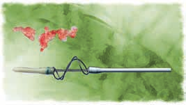 Cateter Fogarty para Coágulo Aderente em Enxerto Para remoção de trombos resistentes de enxertos sintéticos de poliéster e PTFE; Marcações a cada 10cm; Cateter radiopaco e flexível; Espiral em dupla