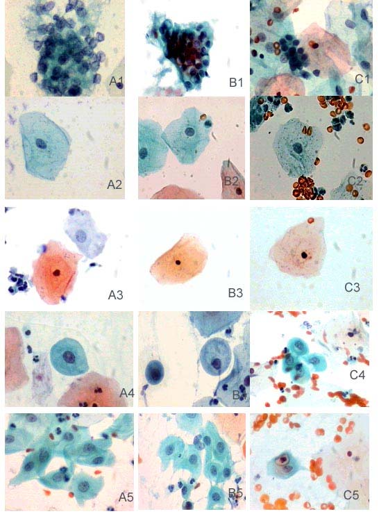 71 A Figura 4 apresenta fotomicrografias das células epiteliais de material cérvico-vaginal, em preparações obtidas de acordo com as metodologias analisadas.