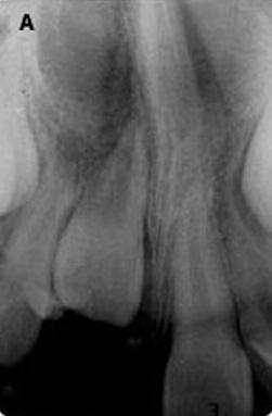 165 Figura 4. Radiografia trans-operatória (A). Dentes decíduos e odontoma composto removidos (B) Discussão Figura 7. Aspecto radiográfico após 90 dias Figura 5.