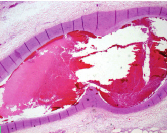 Fig. 5 - Visão externa do ramo interventricular anterior (descendente anterior) da artéria coronária esquerda, mostrando tortuosidade e dilatação. Fig. 6 - Corte histológico de pulmão.