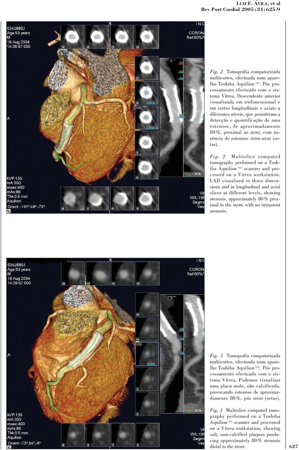 ao stent, com ausência de estenose intra-stent (setas). Fig. 2 Multislice computed tomography on a Vitrea workstation.