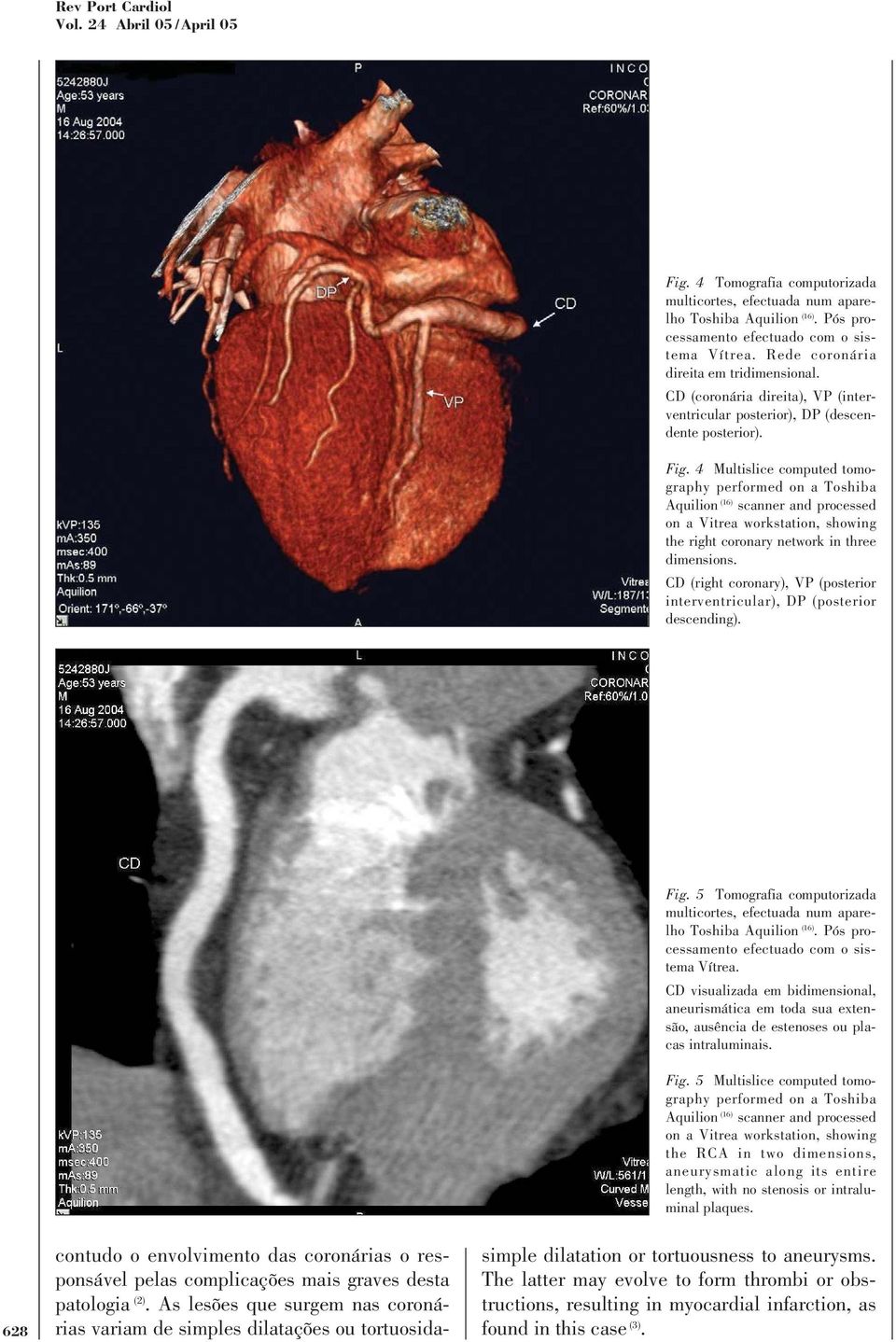 CD (right coronary), VP (posterior interventricular), DP (posterior descending). Fig. 5 Tomografia computorizada Vítrea.