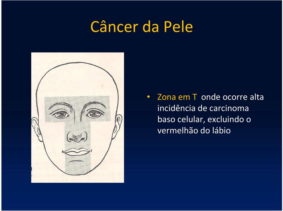 carcinoma baso celular,