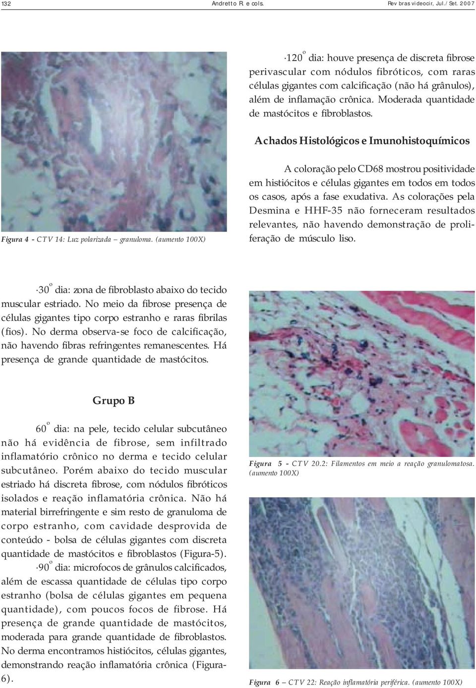 Moderada quantidade de mastócitos e fibroblastos. Achados Histológicos e Imunohistoquímicos Figura 4 - CTV 14: Luz polarizada granuloma.