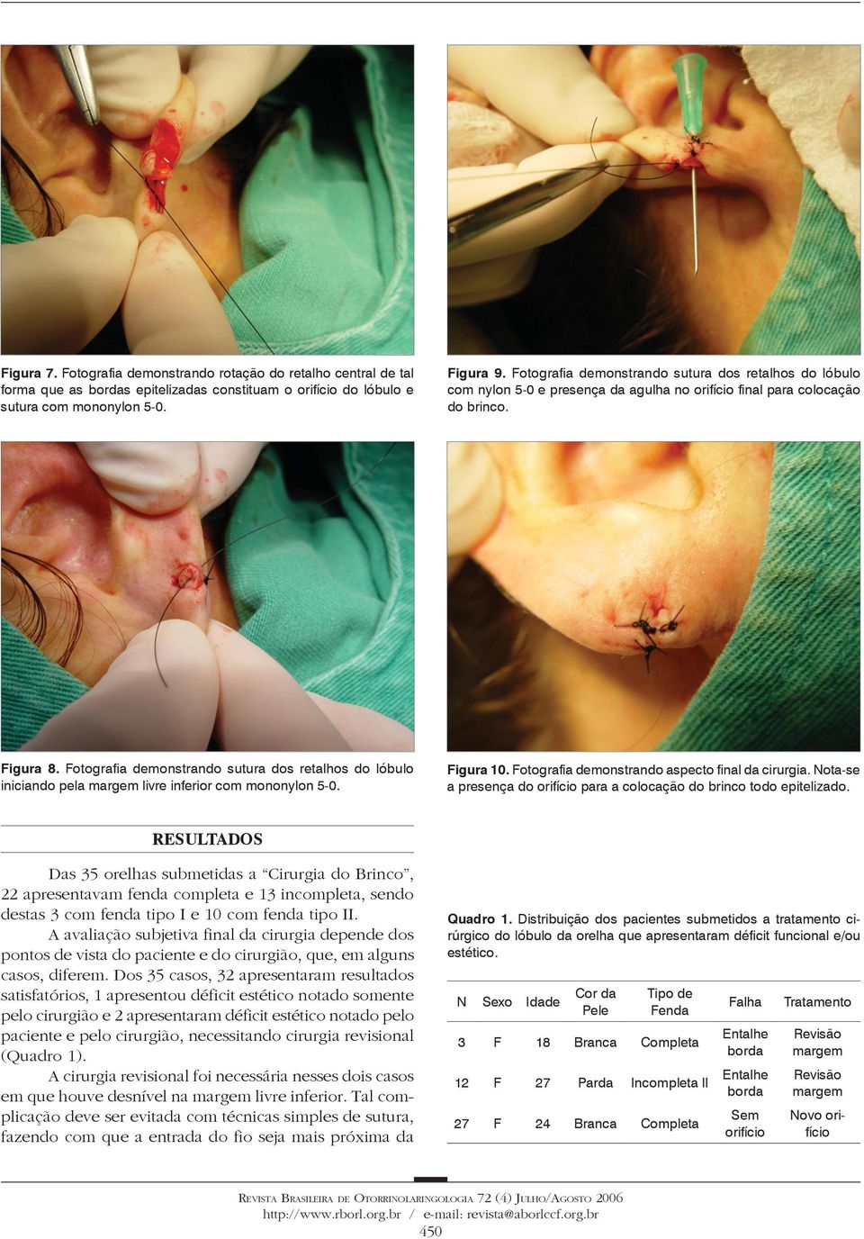 otografia demonstrando sutura dos retalhos do lóbulo iniciando pela margem livre inferior com mononylon 5-0. igura 10. otografia demonstrando aspecto final da cirurgia.
