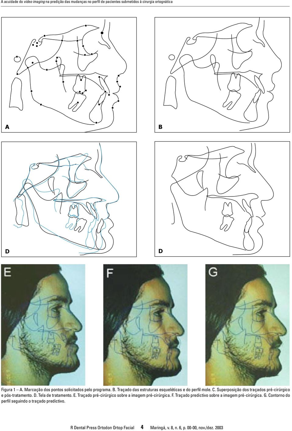 Superposição dos traçados pré-cirúrgico e pós-tratamento. D. Tela de tratamento. E. Traçado pré-cirúrgico sobre a imagem pré-cirúrgica. F.