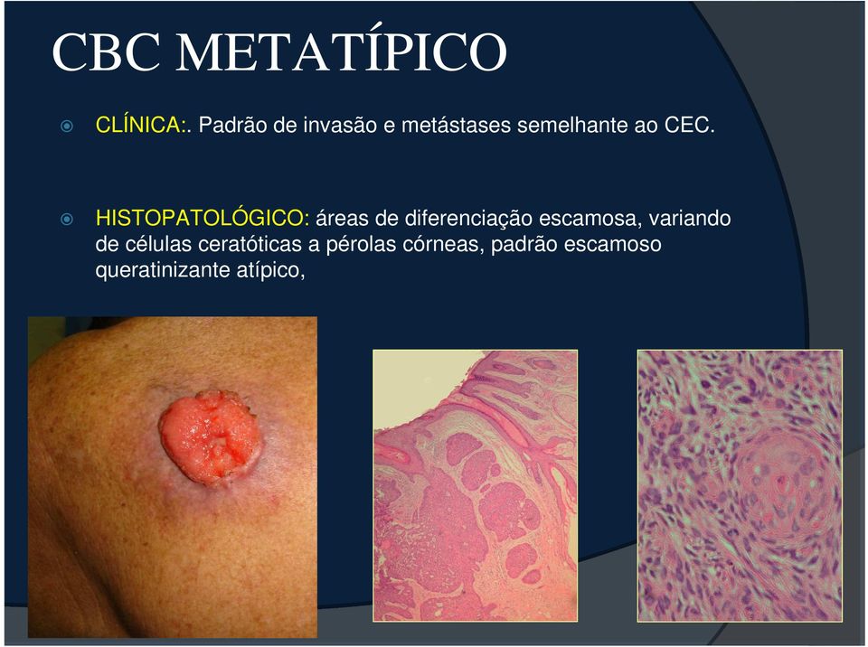 HISTOPATOLÓGICO: áreas de diferenciação escamosa,