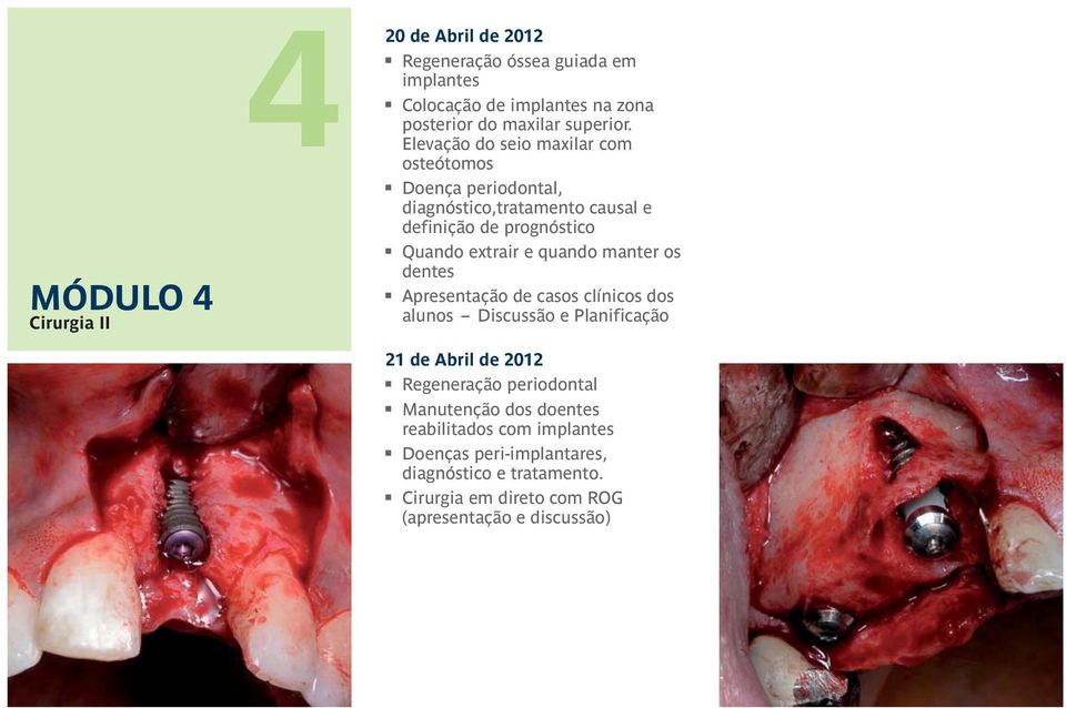 manter os dentes Apresentação de casos clínicos dos alunos Discussão e Planificação 21 de Abril de 2012 Regeneração periodontal Manutenção