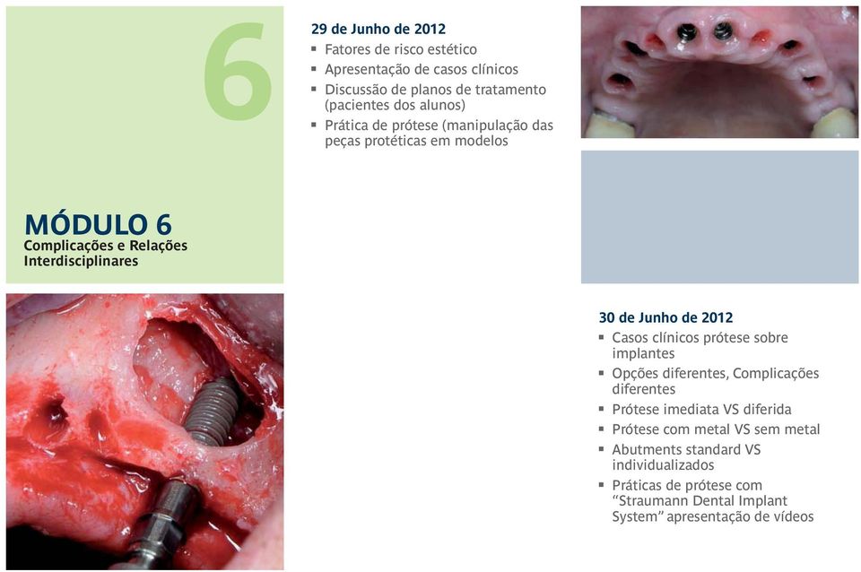 Junho de 2012 Casos clínicos prótese sobre implantes Opções diferentes, Complicações diferentes Prótese imediata VS diferida Prótese