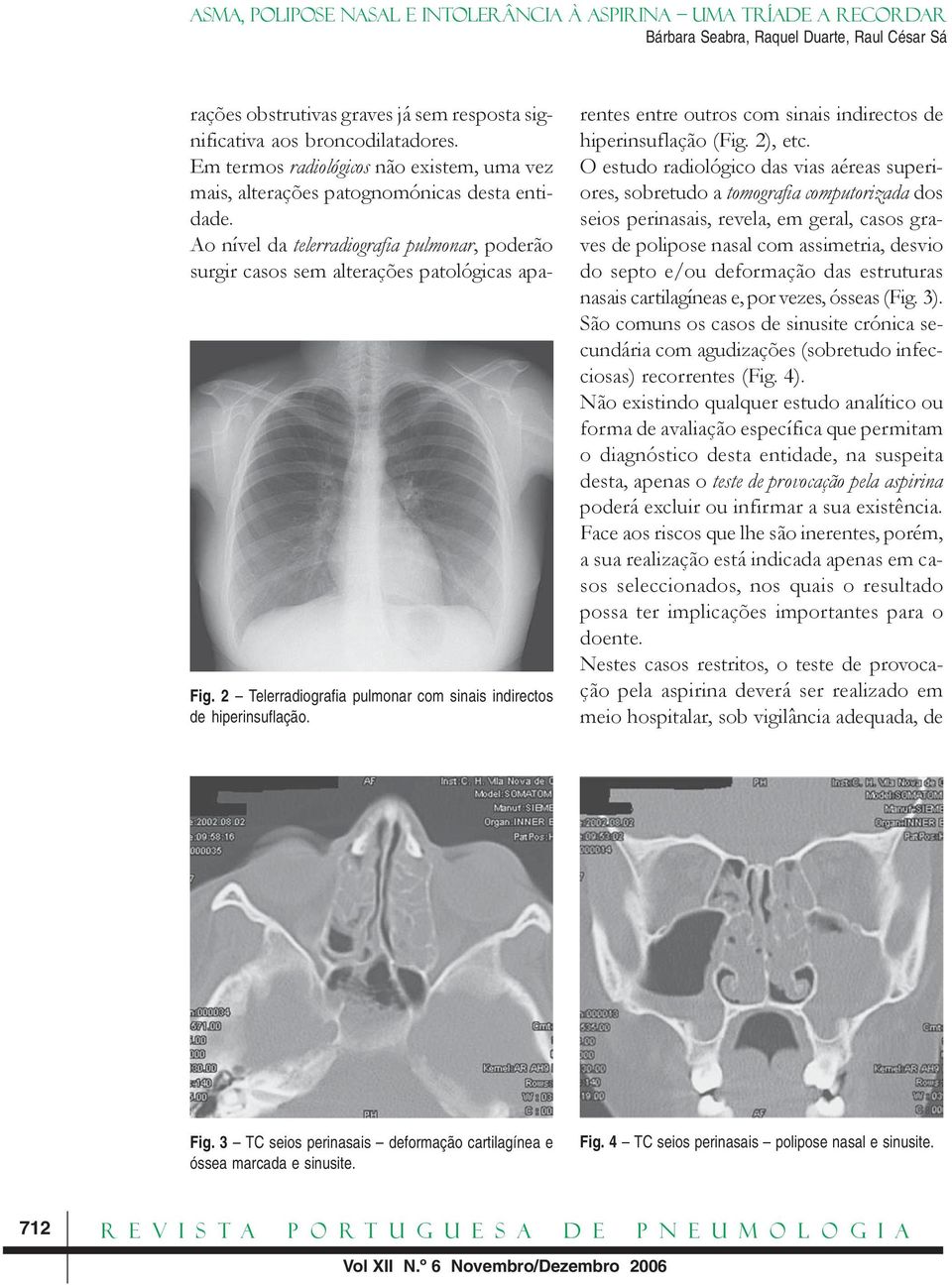 rentes entre outros com sinais indirectos de hiperinsuflação (Fig. 2), etc.