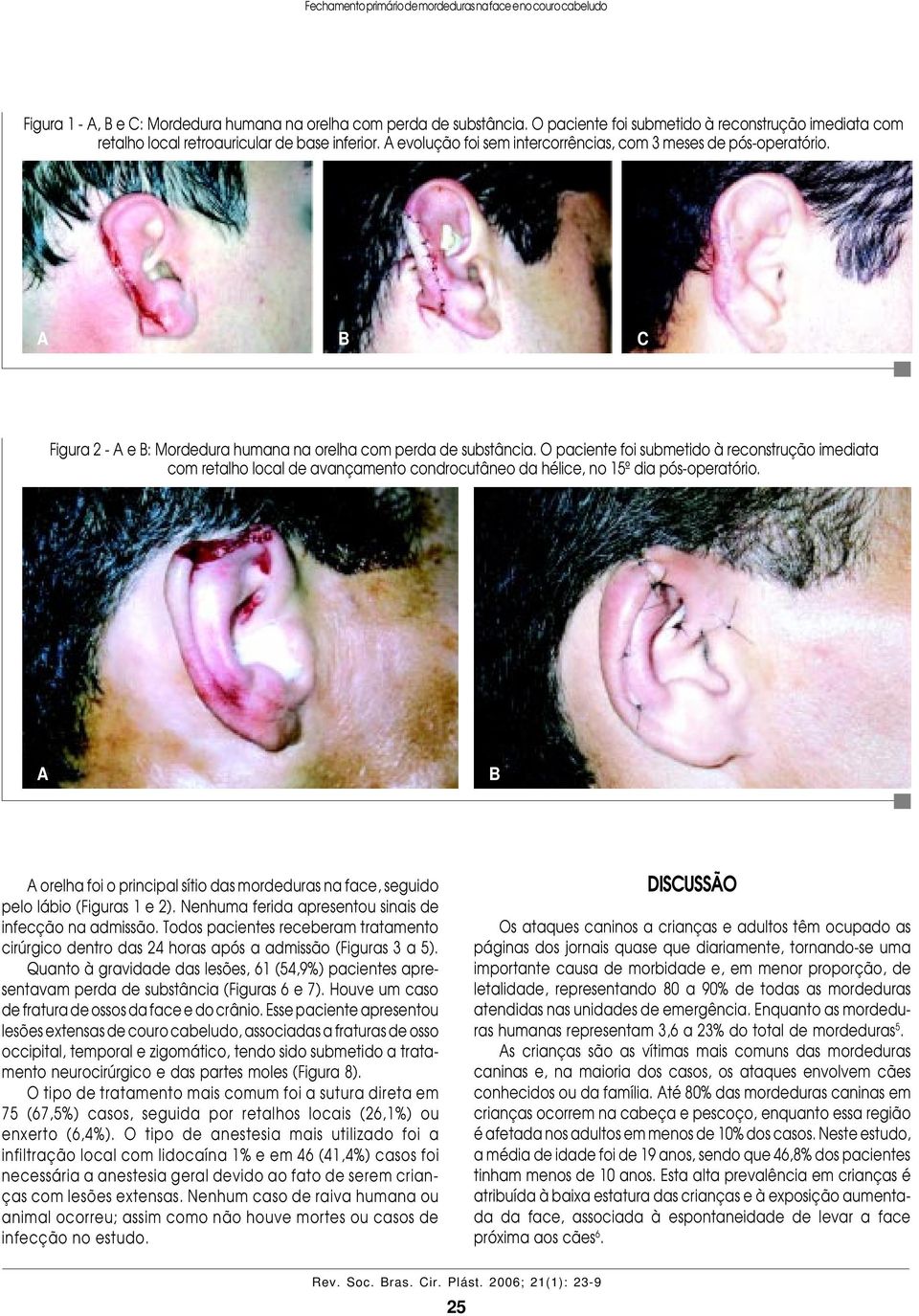 Figura 2 - e : Mordedura humana na orelha com perda de substância. O paciente foi submetido à reconstrução imediata com retalho local de avançamento condrocutâneo da hélice, no 15º dia pós-operatório.