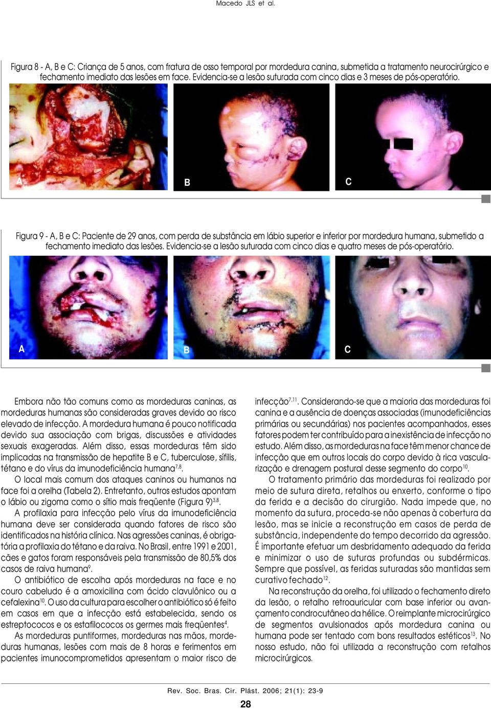 Figura 9 -, e C: Paciente de 29 anos, com perda de substância em lábio superior e inferior por mordedura humana, submetido a fechamento imediato das lesões.