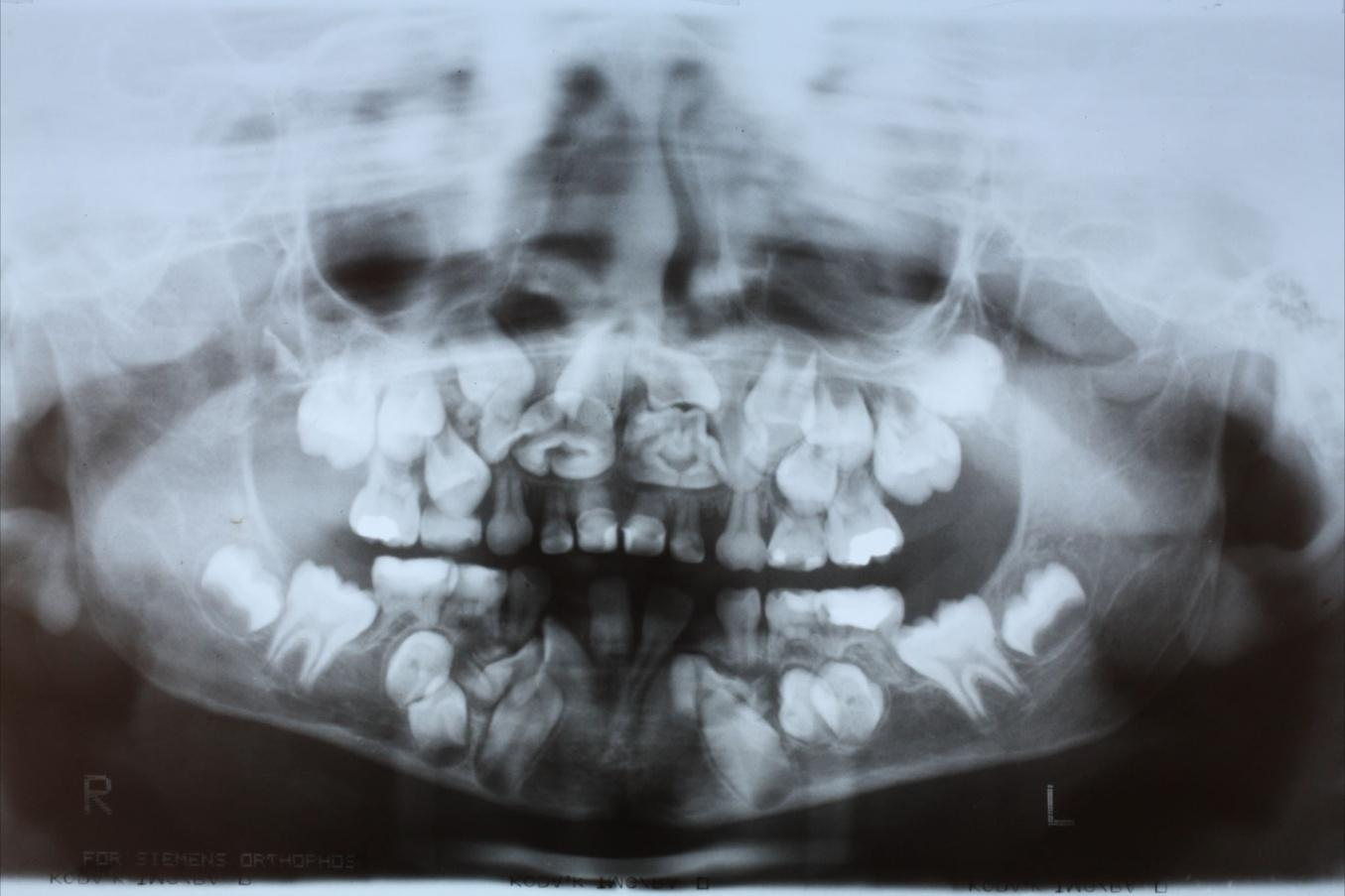 3. RELATO DE CASO Paciente, gênero masculino, 13 anos de idade, leucoderma. Foi encaminhado à Clinica de Especialidades Infantis - Bebê Clínica da U.E.L Londrina- Paraná, com o diagnóstico de DCC aos 5 anos de idade para avaliação e tratamento odontológico.