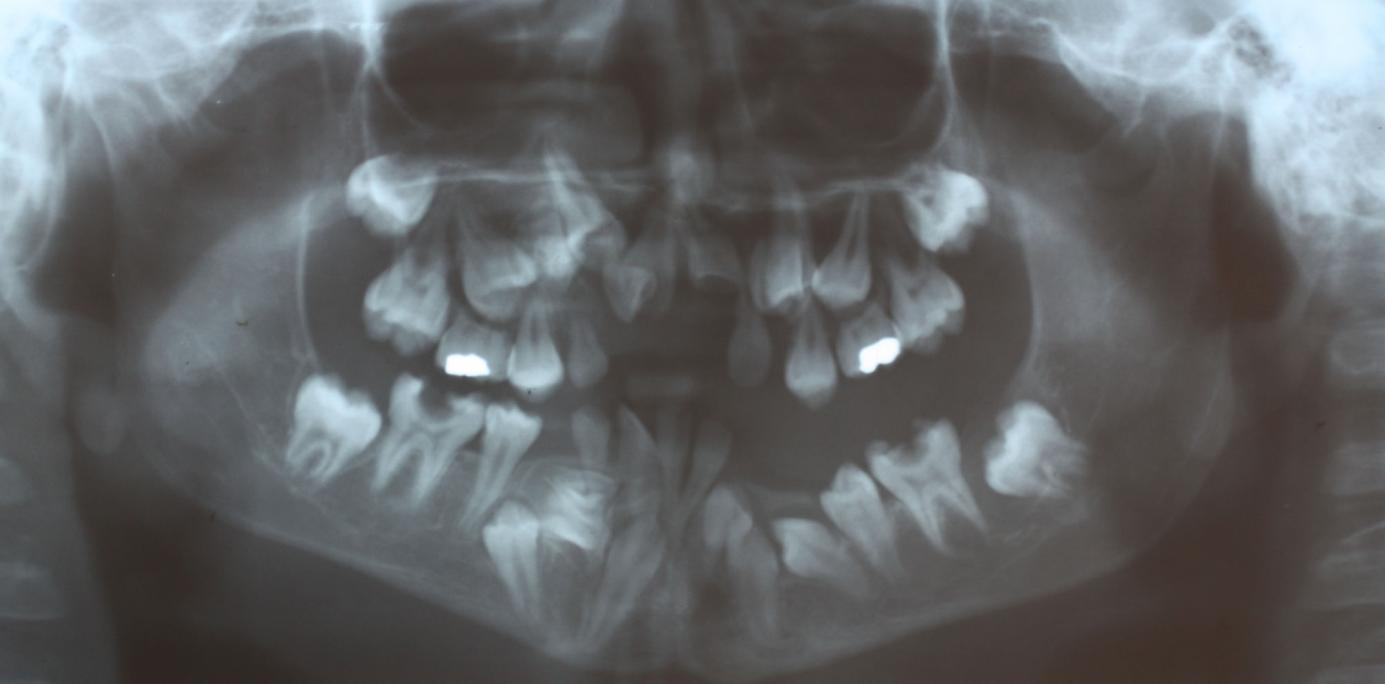 ser um dente supranumerário, outro na região de primeiro pré-molar superior direito (14) e outro na região