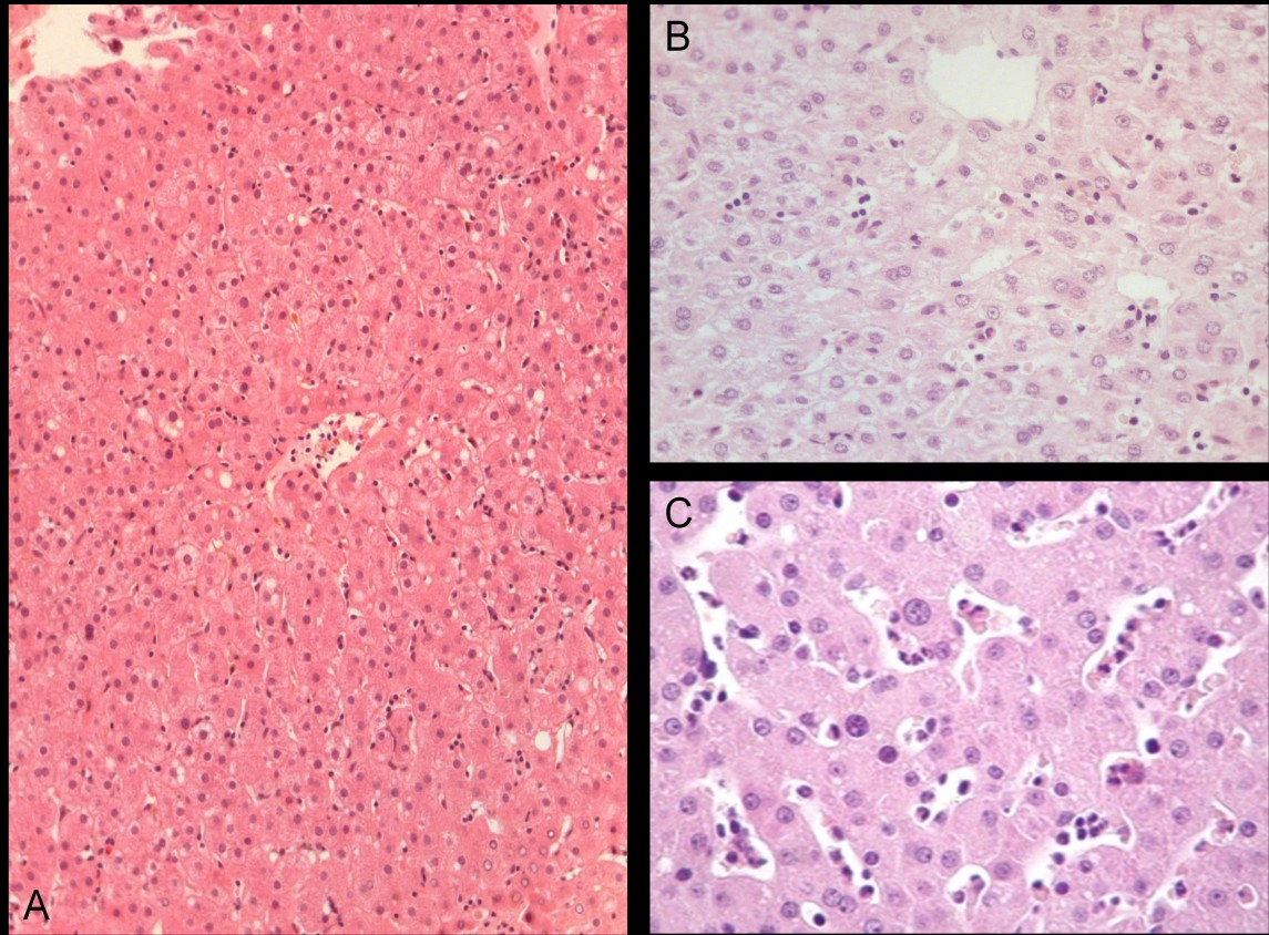 3 Figura 7. Avaliação de infiltrado inflamatório lobular. A Infiltrado inflamatório linfocitário moderado (Hematoxilina e eosina x). B Infiltrado inflamatório misto leve (Hematoxilina e eosina x).