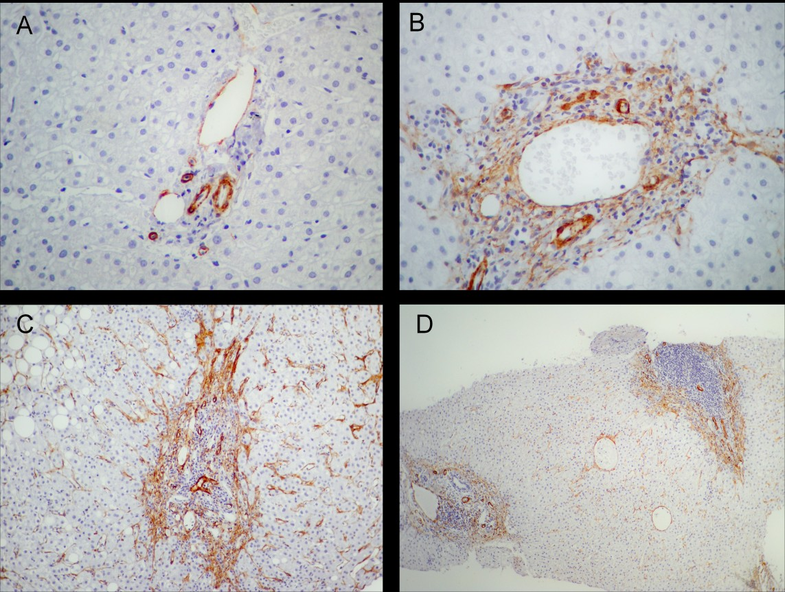 Figura 3. Avaliação de células estreladas hepáticas por exame imunohistoquímico com marcação para actina de músculo liso. A Ausência de células marcadas em espaço porta (x).