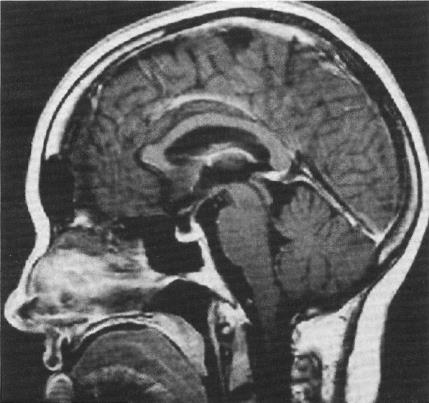 tumoral das principais estruturas vasculares. (NOBREGA, 2006). Plano Sagital (NACIF, 2011) Aparelho de Ressonância Magnética - Campo aberto http://centrodediagnosticos.com.br/ressona cia.