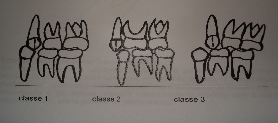 89 - Mordida aberta anterior: (0) não (1) sim Sim, será atribuído quando houver, em MIH, falta de contato vertical entre os dentes anteriores.