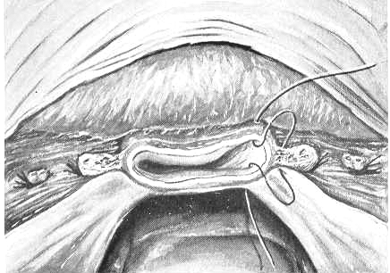 Pacientes e Métodos 64 Figura 13 - Abertura da cúpula vaginal ao nível do colo uterino (Adaptado de