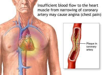 ANGINA Desconforto no tórax, tipicamente provocada por ansiedade ou esforço e aliviada após alguns minutos em repouso; Ocorre quando o fluxo de sangue através de uma artéria coronária é reduzido a