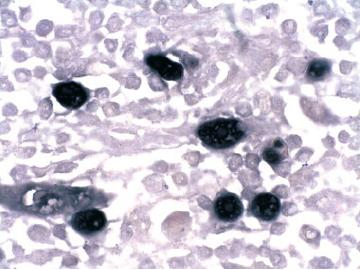 a existência de resposta dos LTC aos epítopos virais, ao contrário do que se sucede com o genótipo HLA-A*02, associado à diminuição do risco de linfoma.