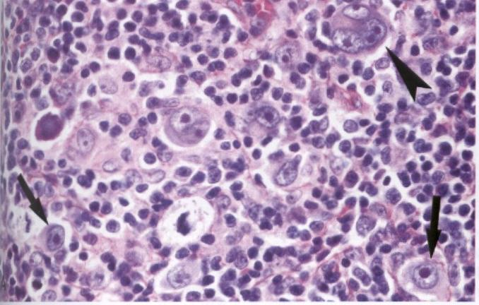 Figura 7. Histologia de um gânglio linfático de um doente com LH.