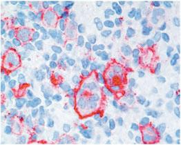 germinal center-associated lymphoma protein), a centerina e a AID (activation-induced cytidine deaminase), são também expressos pelas células LP. 14 Figura 15. LHPLN.