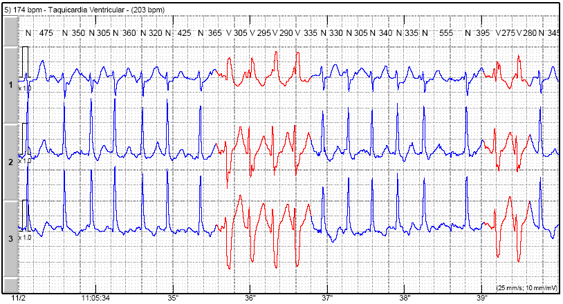 Figura 1 B Registro eletrocardiográfico do mesmo paciente, obtido às 11:05 h, apresentando fibrilação atrial com frequência ventricular média de 174 bpm e um episódio de taquicardia ventricular