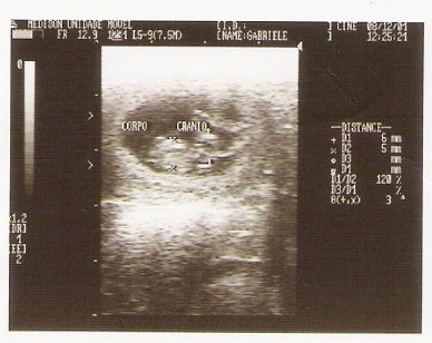 24 FIGURA 5 - IMAGEM ULTRA-SONOGRÁFICA MODO B, COM TRANSDUTOR DE 7,5 MHz, AOS 32 DIAS DE GESTAÇÃO EM CADELA DA RAÇA YORKSHIRE ILUSTRANDO A MENSURAÇÃO DO DIÂMERO DO CORPO E DIÂMETRO BIPARIETAL (mm).