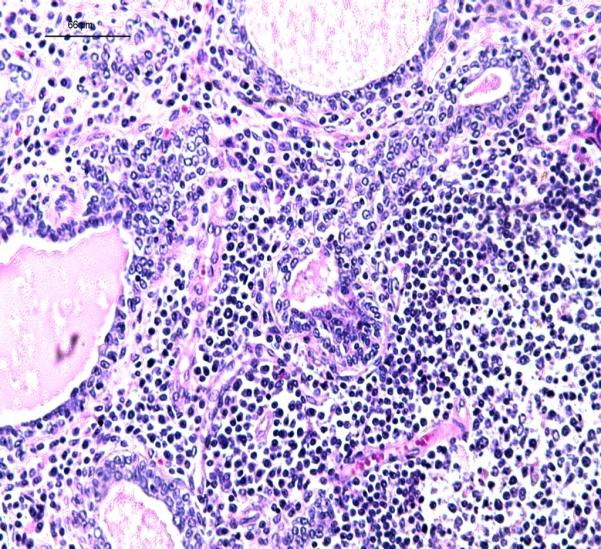 6 A B FIGURA 3 - Fotomicrografia de próstata canina com foco de atrofia inflamatória proliferativa (PIA).