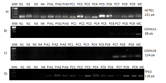 69 TABLE2 -Comparison between p21, p27, and p53 immunostaining regarding number of stained cells and intensity of staining in canine normal prostatic tissue, PIA and PC.